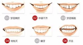 整牙的费用大概多少钱（牙齿矫正）