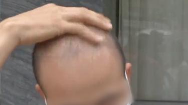 种植5000根头发多少钱（每根7元）