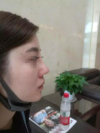 墊鼻大概多少錢（寧波26歲女子花5萬元整容）