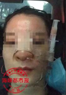 泉州假體隆鼻要多少錢（到）