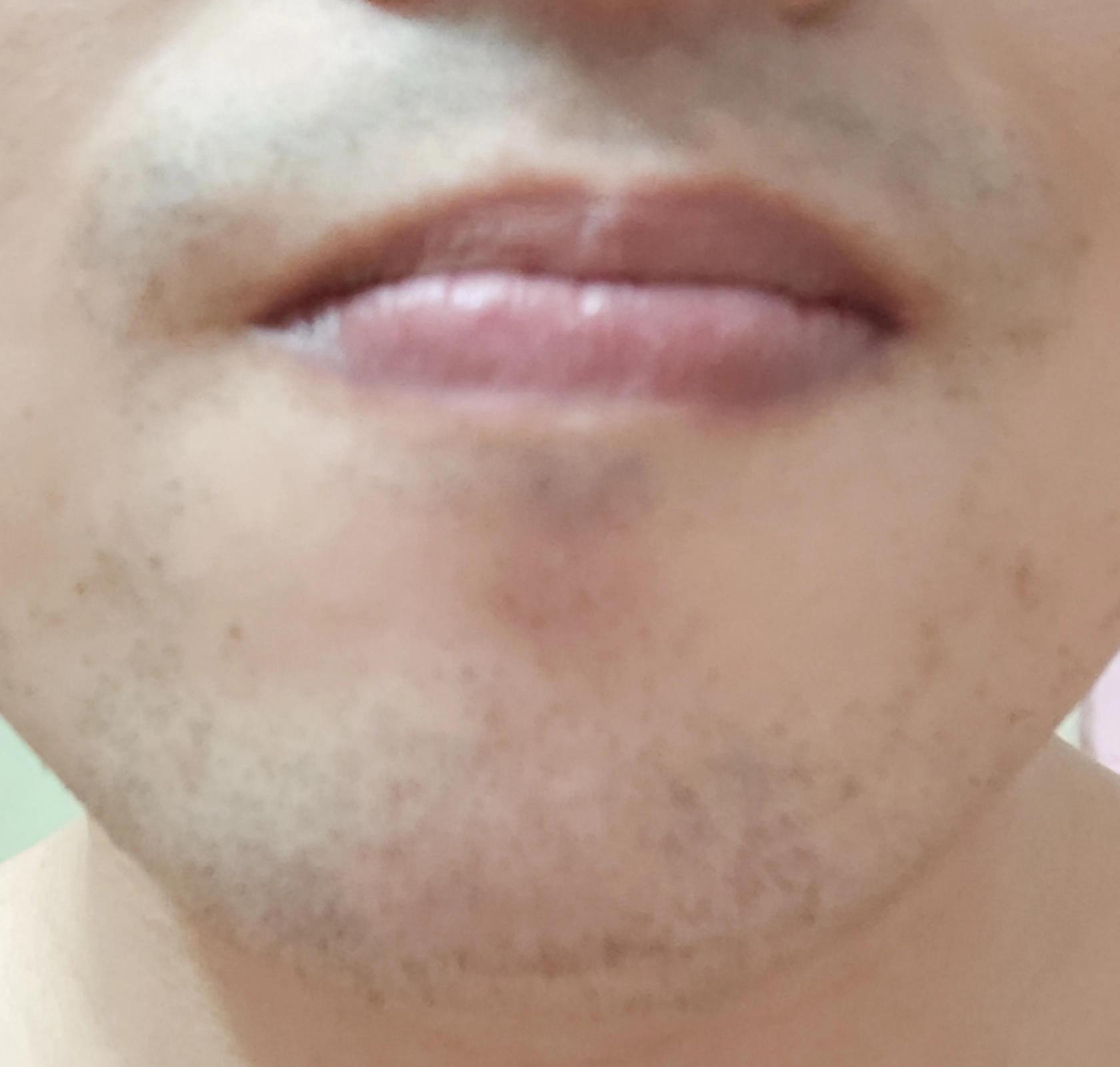 胡子激光脱毛的价格多少（本人亲测脱毛仪脱胡须记录贴）
