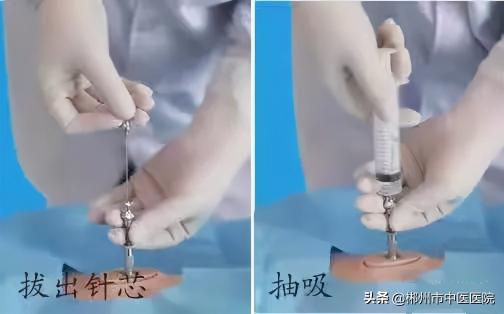 做一次骨髓穿刺多少錢（骨髓穿刺是怎么回事）