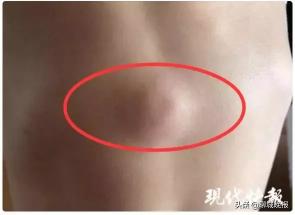 皮下囊肿切除手术多少钱（3岁男孩身上包块会）