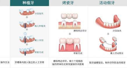 鑲牙哪價格低(掉牙后)