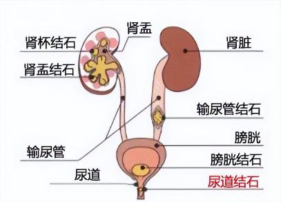 体外碎石术需要多少钱（泌尿系结石）
