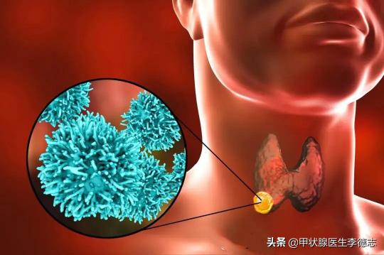 甲状腺手术需要多少钱（甲状腺癌到了医院做手术治得好吗）