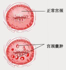 做宫颈囊肿手术需要多少钱（宫颈囊肿听着吓人）
