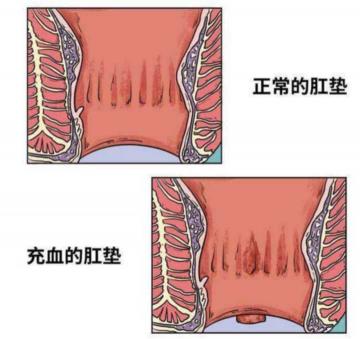 割外痔需要多少钱（不同的痔疮都是怎么治疗的呢）