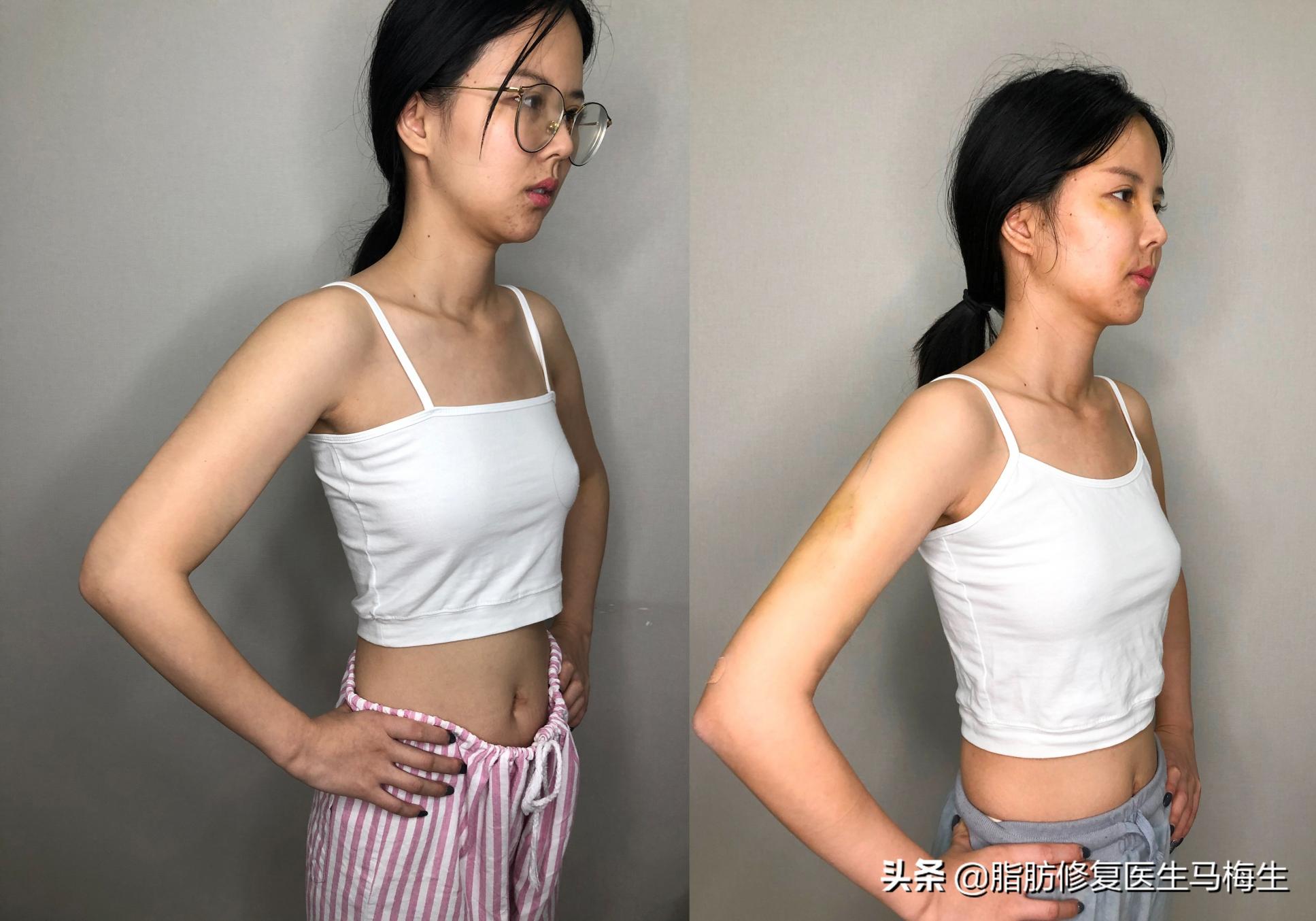 手臂抽脂多少錢（25歲小姐姐手臂吸脂60天）