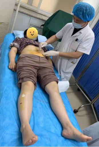 埋线减肥大概要多少钱（持续刺激）