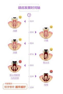 根管多少钱（根管治疗）