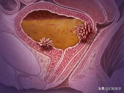 灌注化疗一次多少钱（膀胱肿瘤术后如何规范实施灌注化疗）