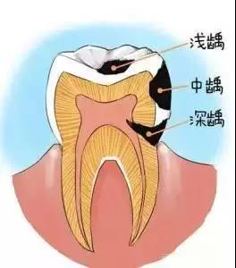 补牙洞价格多少钱一颗（为啥补牙不能一次完成）