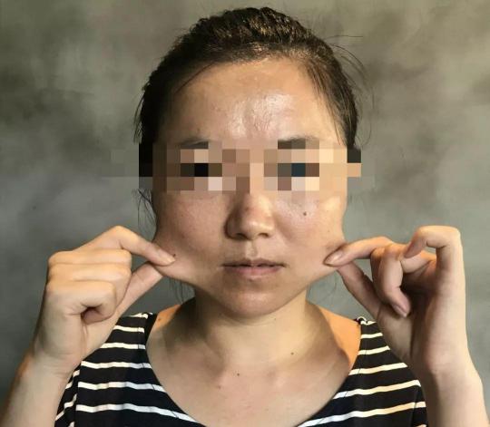 瘦臉針大概多少錢一支（女孩打了一針）