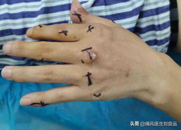 痛风石手术大概多少钱（长出痛风石不要紧）