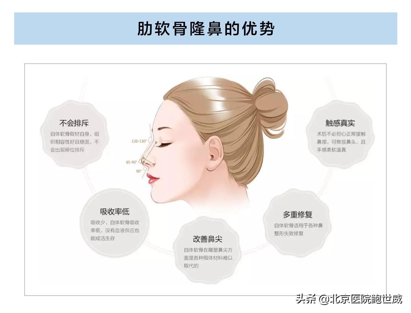 肋软骨隆鼻多少钱（肋软骨隆鼻的优劣势分析）