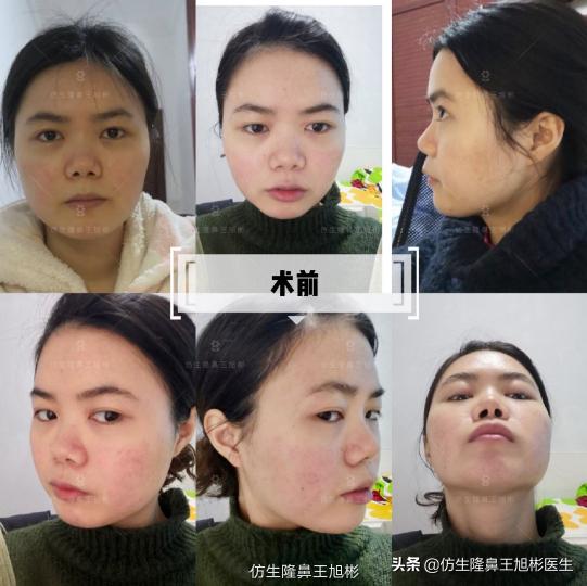 垫鼻大概多少钱（湖南学生圆圆肋软骨垫鼻尖）