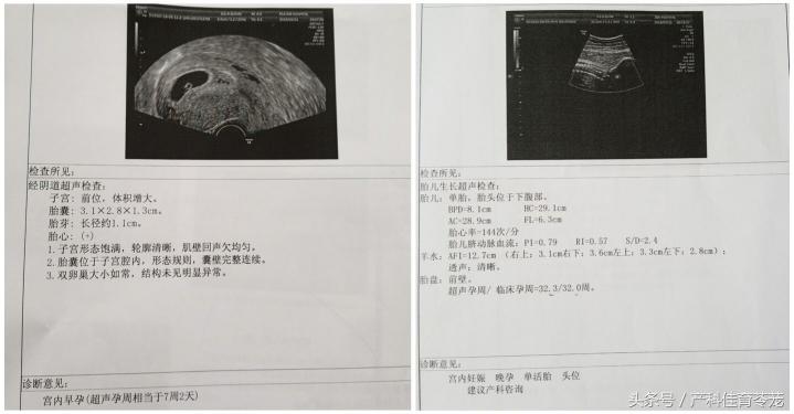 一次B超多少錢（孕期B超）