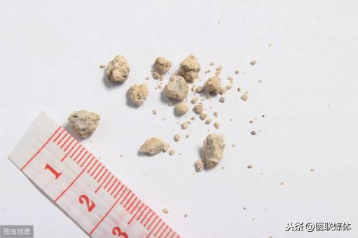 1打结石多少钱（肾结石一发作就疼得要命）