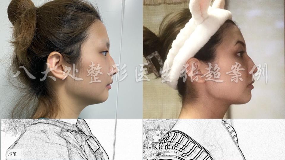脸部抽脂需要花多少钱（八大处张超面部吸脂案例合集）