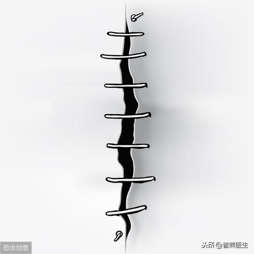 拆线一般多少钱（医生）