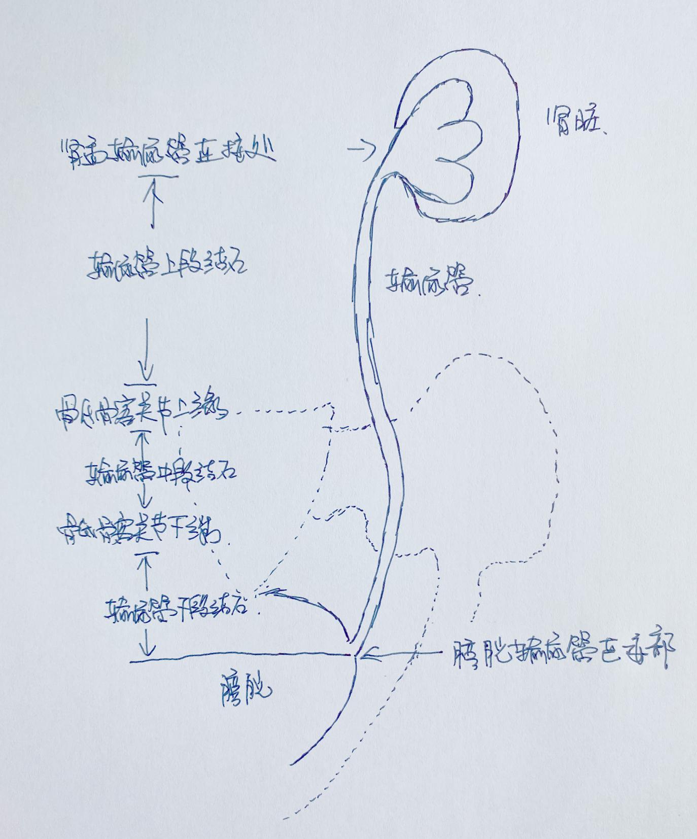 输尿管结石手术大概多少钱（输尿管结石怎么处理）
