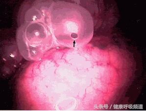 治肺大泡多少钱（肺气肿和肺大泡到底有何区别）