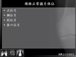 颈椎片子多少钱（颈椎X光片）