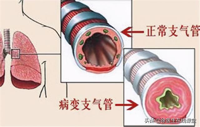 哮喘检查大概多少钱（怀疑得了哮喘需要做哪些检查）