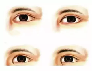 開內(nèi)眼角多少錢（明明有內(nèi)眥贅皮）