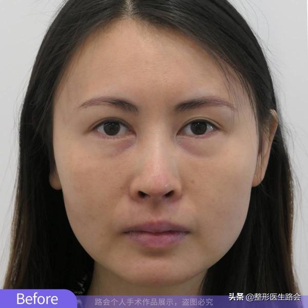 苏州膨体隆鼻多少钱（苏35岁沈女士）
