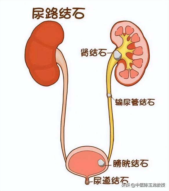 碎石需要多少钱（一个治结石非常好用的中药方）