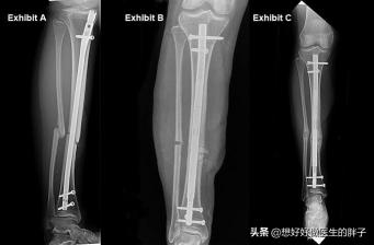 小腿骨折手术多少钱（小腿骨折易发生骨不连）