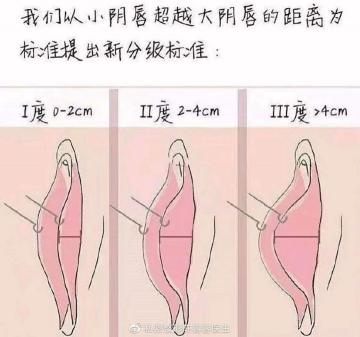 私密整形需要多少钱（你真的有必要进行小阴唇整形吗）