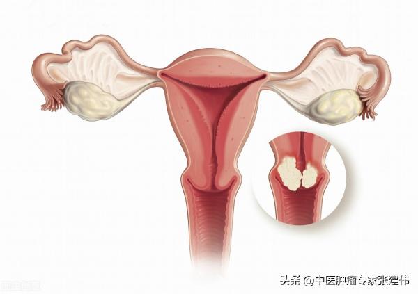 检查tct和hpv多少钱（宫颈癌筛查怎么做）