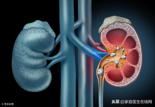 结石手术需要多少钱（肾结石要做手术才能取出）