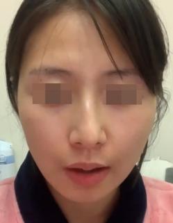 歪鼻手术多少钱（歪斜的鼻子应该如何矫正治疗）