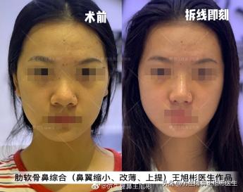 鼻部整形一般多少钱（常见鼻整形项目案例合集）