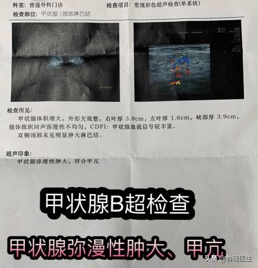 甲亢手术多少钱（门诊手记）