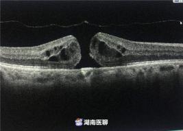 眼部oct检查多少钱（男子黄斑裂孔视力下降）