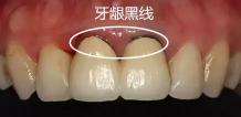 一个烤瓷牙套大概多少钱（听说）
