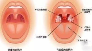 割扁桃体多少钱（扁桃体发炎在家怎么吃药）