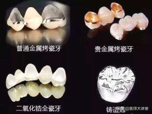 安装假牙要多少钱（很纠结）