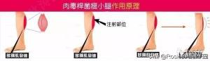 注射瘦小腿需要多少钱（想快速瘦小腿）