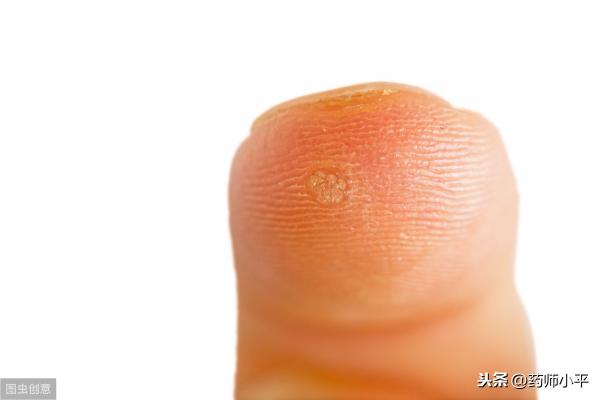 冷冻疣多少钱（扁平疣可以根治吗）
