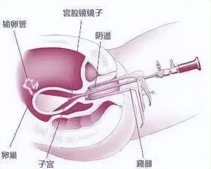 宫腔镜一般多少钱（宫腔镜检查到底痛不痛）