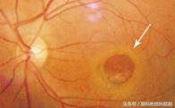 黄斑裂孔手术多少钱（眼睛里的黄斑指的是什么）