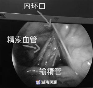 睾丸手术多少钱（2岁宝宝先天睾丸）