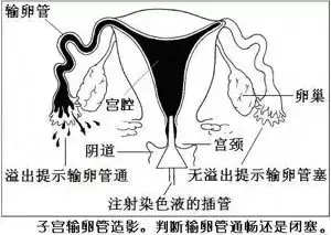 造影输卵管多少钱（4步讲解输卵管造影检查过程）