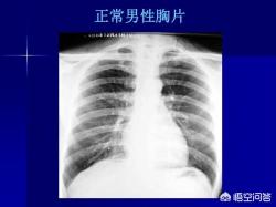 肺部x光多少钱（胸片便宜又辐射小）